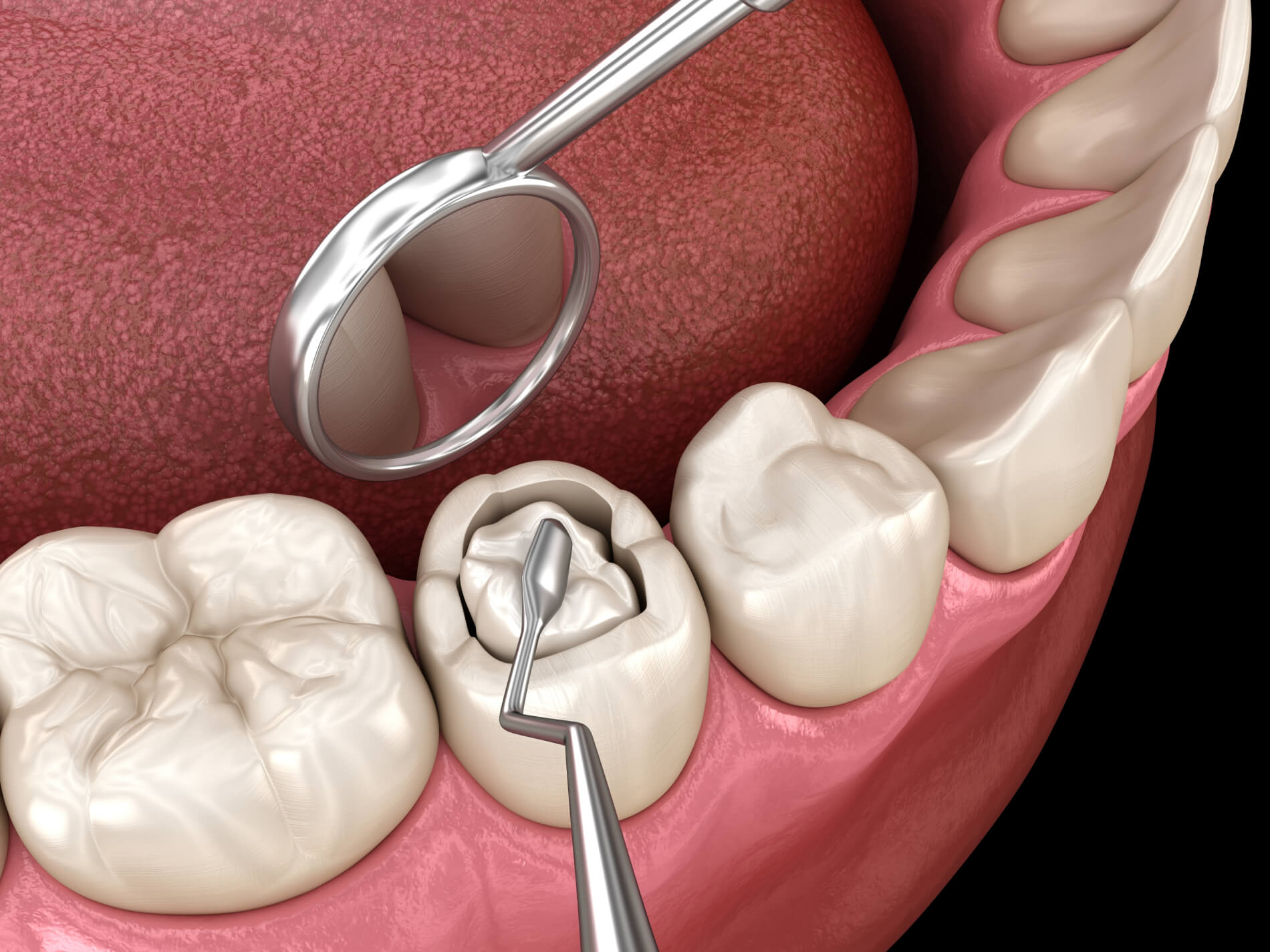 Decayed Tooth Restoration Composite Filling Dental