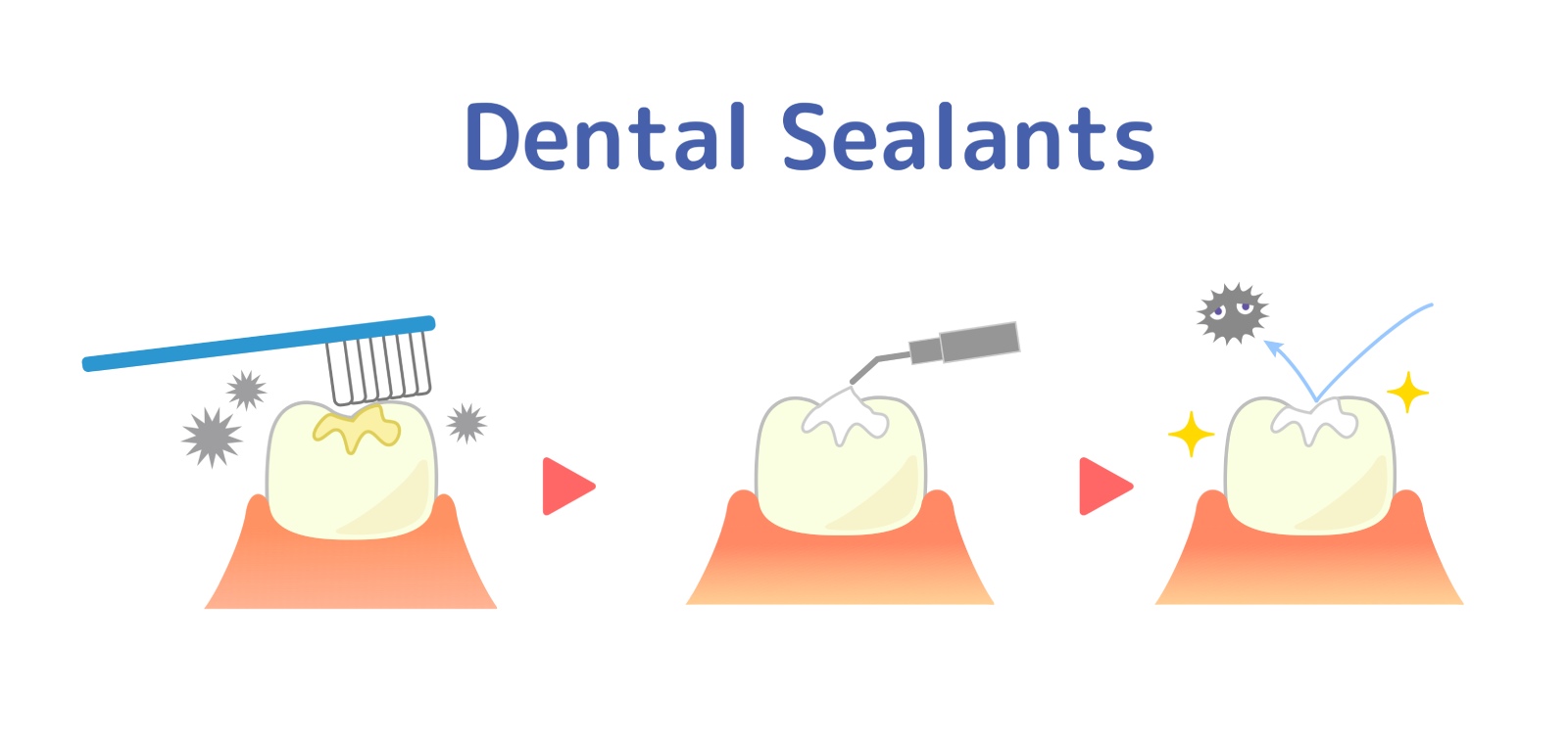 The Dental Sealant Process