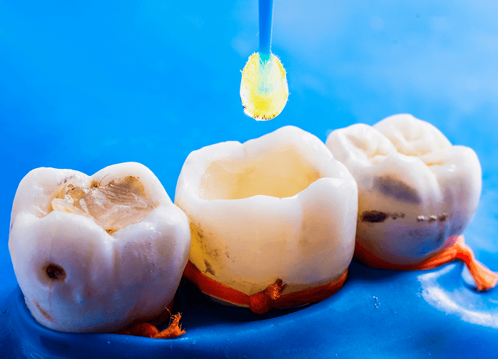 What Are Dental Fillings?