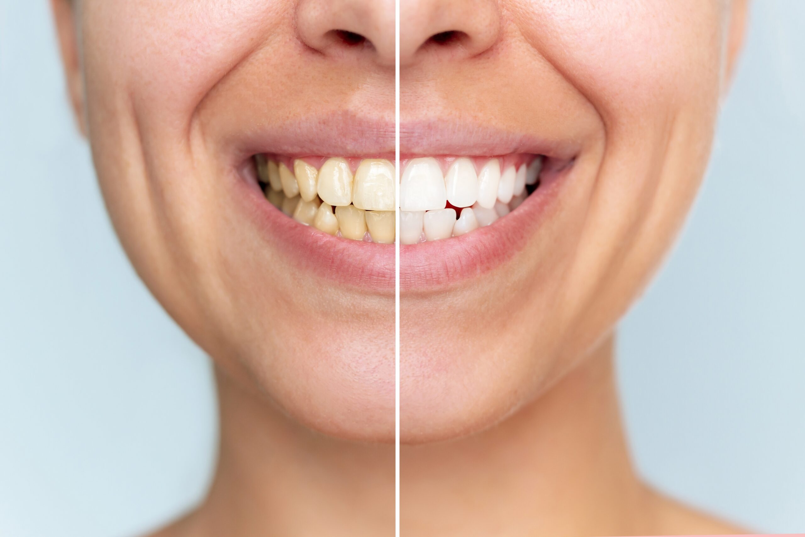 The Truth About Teeth Whitening
